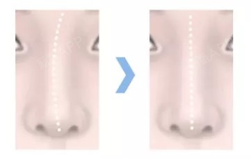 首页 此页面仅支持预览 Avatar 北京新面孔医疗美容诊所 240篇日记 歪鼻整形是按照歪鼻的原因 1对1的设计定制型手术计划 考虑整体和面部的协调以及客人喜欢的鼻子模样 不单纯是美的改善 连带肌能性的问题可以同时得到解决 注 X光面部平扫