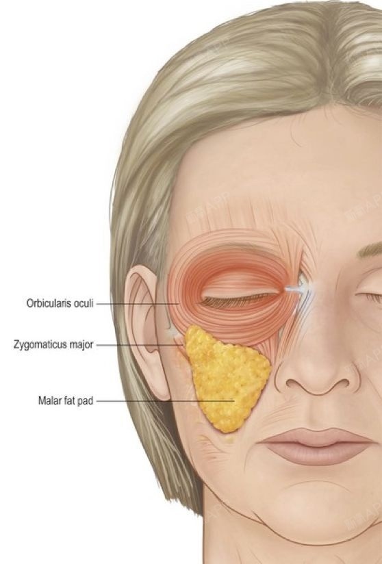 法令紋上方軟組織松垂坍塌(顴脂肪墊下移,局部軟組織增厚,皮膚