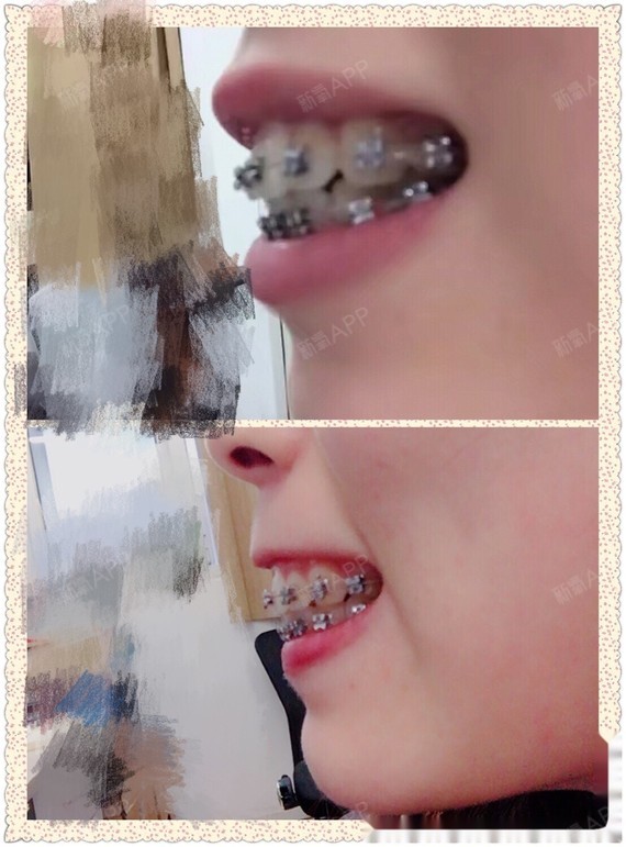 E刚带牙套的照片 忘了拍侧面 主要问题是骨性龅牙 圈子 新氧美容整形