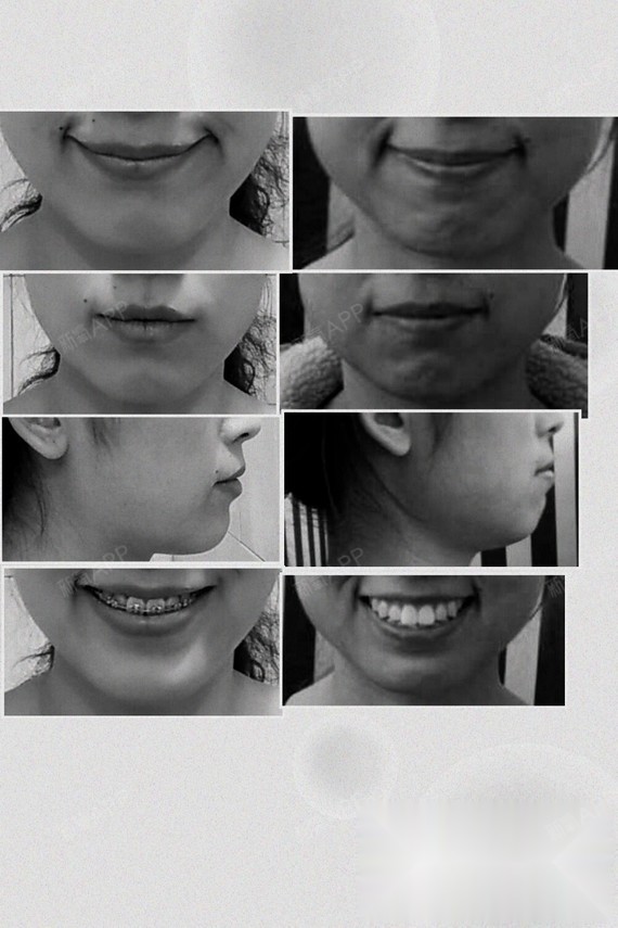 左正畸中 右正畸前绝对会 我是国字脸 肉脸大脸颧骨_圈子-新氧美容