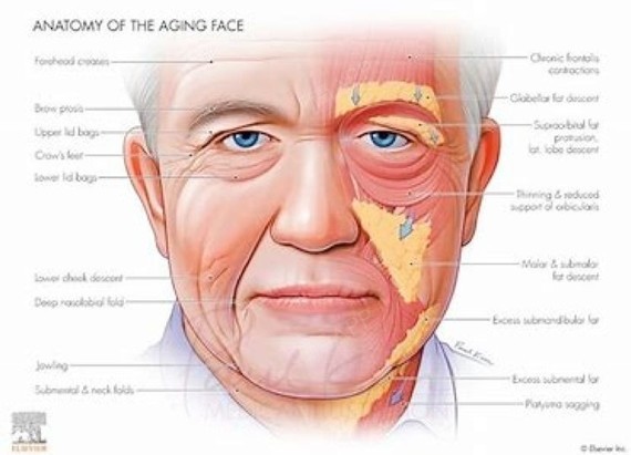 法令纹上方软组织松垂坍塌(颧脂肪垫下移,局部软组织增厚,皮肤