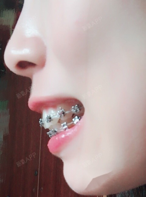 E刚带牙套的照片 忘了拍侧面 主要问题是骨性龅牙 圈子 新氧美容整形