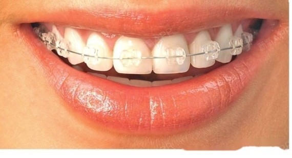 牙套的类型图片图片