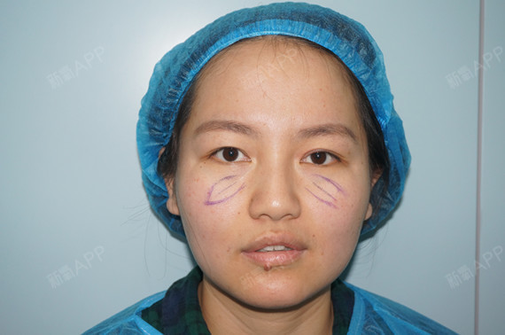 内切去眼袋好不好_效果图_氧气yz6t0内切去眼袋术后第1天_新氧美容