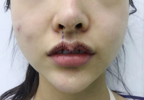 手术第一天:项目:m唇 唇珠