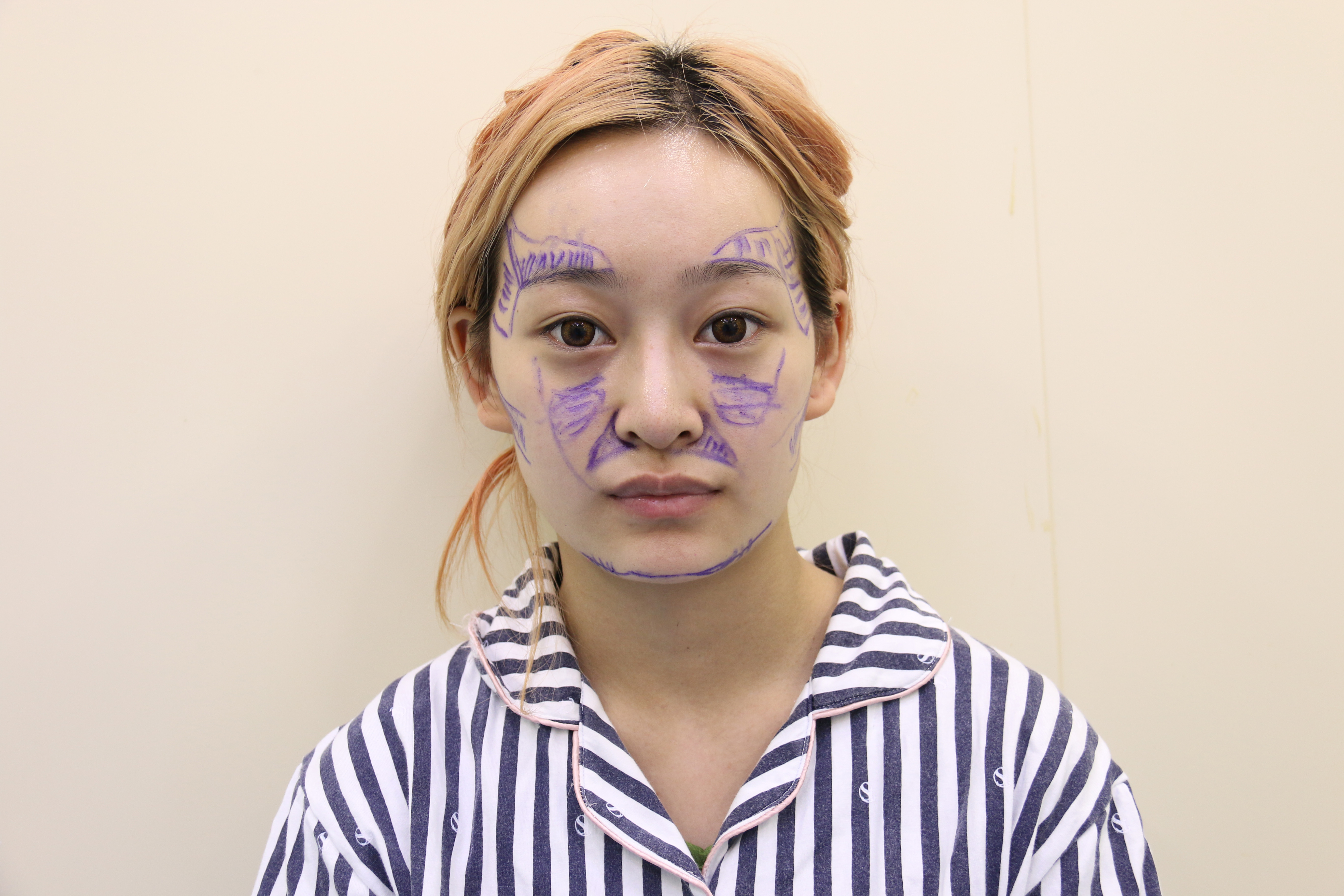 自体脂肪填充面部后,如何进行消肿护理?
