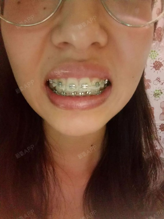 戴牙套75天因为投资自己什么时候都不晚