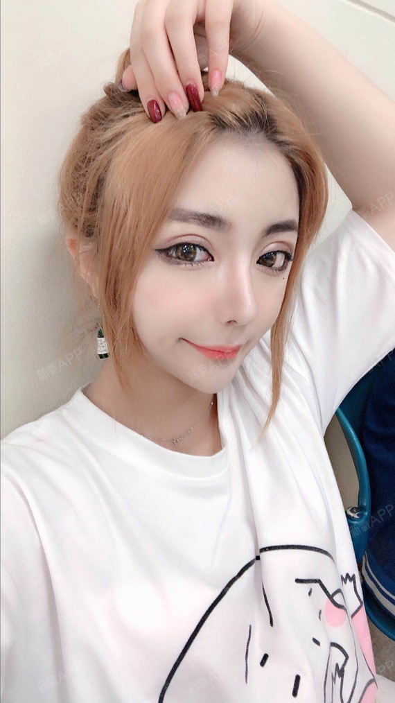 切开双眼皮好不好_效果图_刘黎明切开双眼皮术后第34天_新氧美容整形