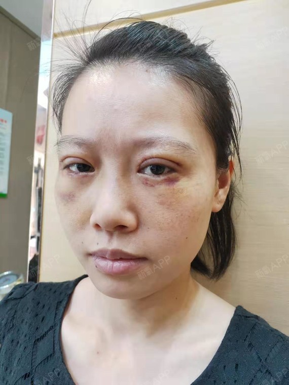 眼袋因为是内切的所以没有伤口,所以不需要拆线什么的哦,只是现在还有