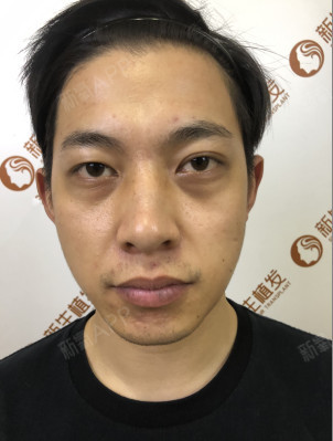新生男人植发(男生植发生长过程记录)
