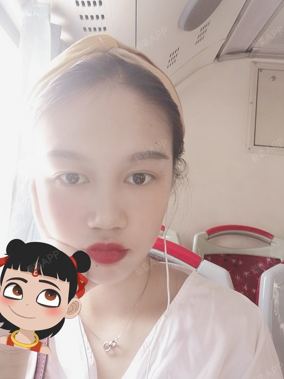 泸州切开双眼皮好不好_效果图_泸州陈清整形医学美容门诊部切开双眼皮