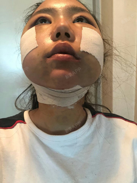 韩国面部吸脂经验分享一波啊