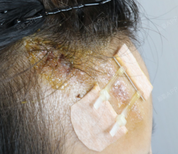 被医生催着过来拆线我应该是头一个吧