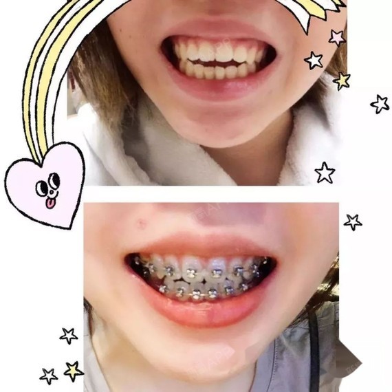 牙齿开颌.从小学就开始了27岁.觉得开颌影响了下半_圈子-新氧美容整形