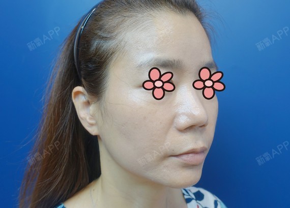 肉毒素瘦脸针 轮廓针 去皱针 5个月后