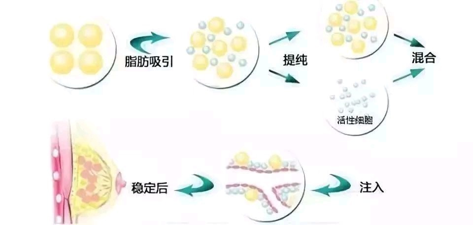 最安全的丰胸方法是什么 自体脂肪丰胸 新氧美容整形