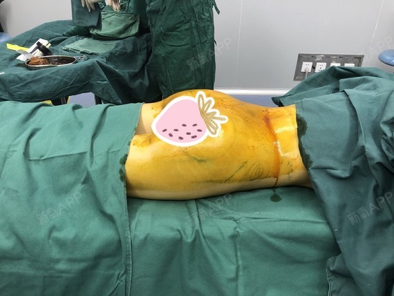 我去年夏天在其他医院做了大腿吸脂和自体脂肪填臀,我本身比较瘦,身高