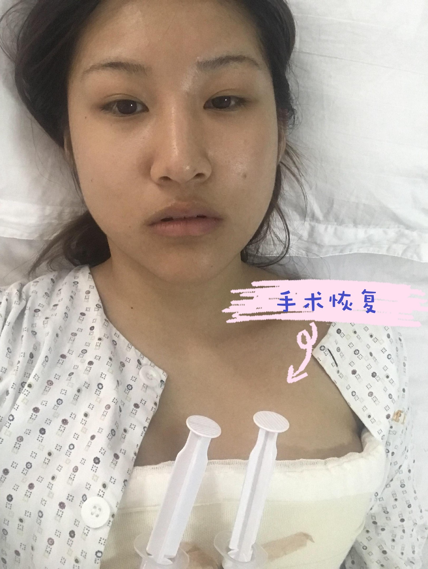 一边吸脂一边隆胸自体脂肪就是这么牛