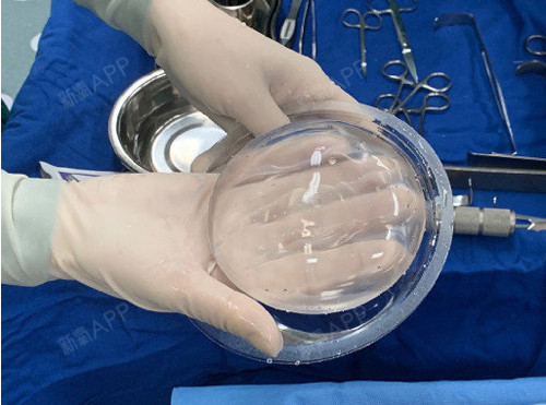 光面假体:在柔软度及手感上,毛面假体更胜一筹.