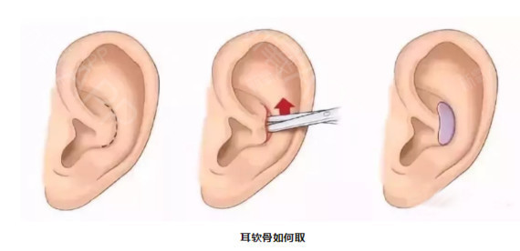 耳軟骨不夠隆鼻嗎