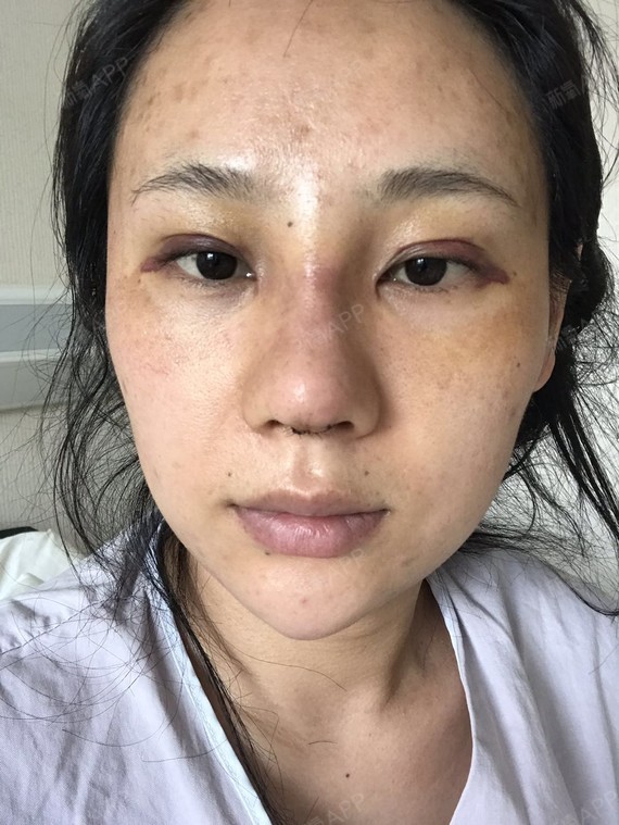 肋骨隆鼻第七天