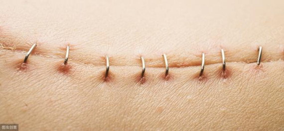 首页 此页面仅支持预览 Avatar 氧气4c3bv 7篇日记 剖腹产伤口多久恢复为什么你的剖腹产疤痕比别人难看 剖腹产伤口多久恢复剖腹产的伤口 深而长 剖腹产伤口多久恢复对于产妇有着重大的意义 因为剖腹产和其它手术人群康复能力完全不一样 在手术之后