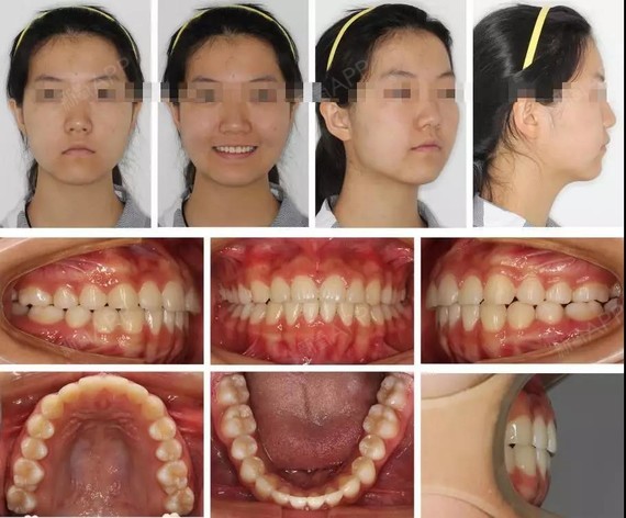 16岁金属自锁托槽种植支抗压低上前牙打开咬合病 例_圈子-新氧美容