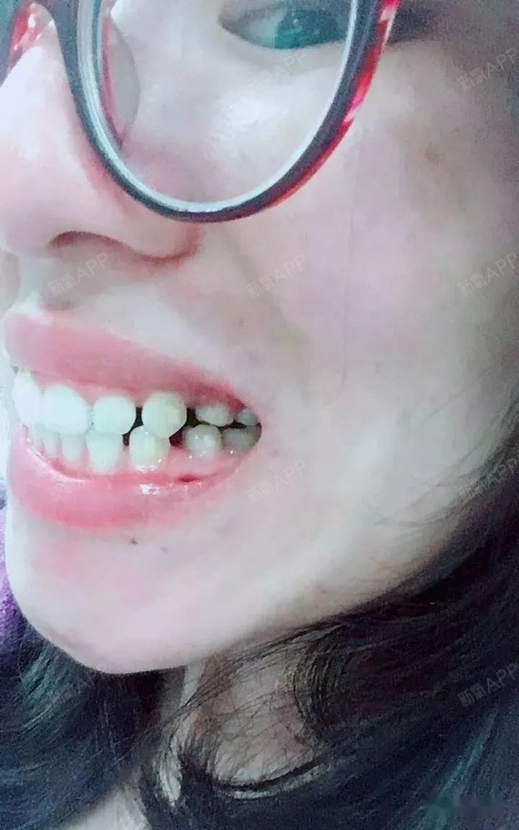 骨性牙性龅牙开颌隐适美1年效果