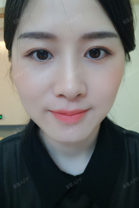 平行型双眼皮