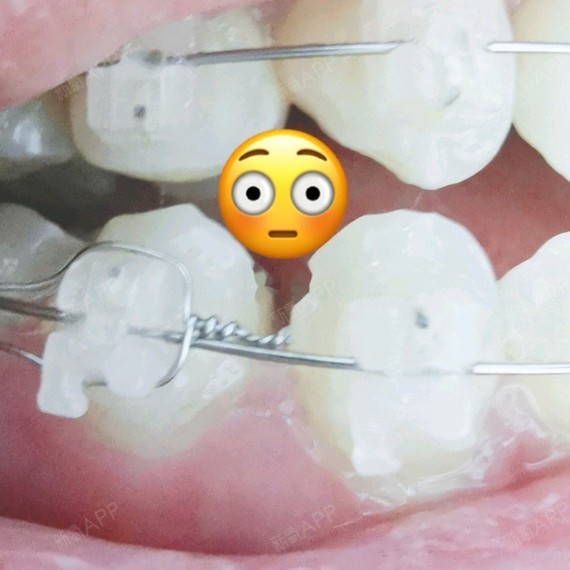 片切正畸26岁牙齿矫正牙齿牙齿不齐整牙参考