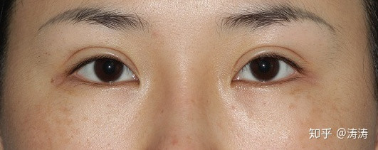 双眼皮术后后悔的话还可以做回去吗 新氧美容整形