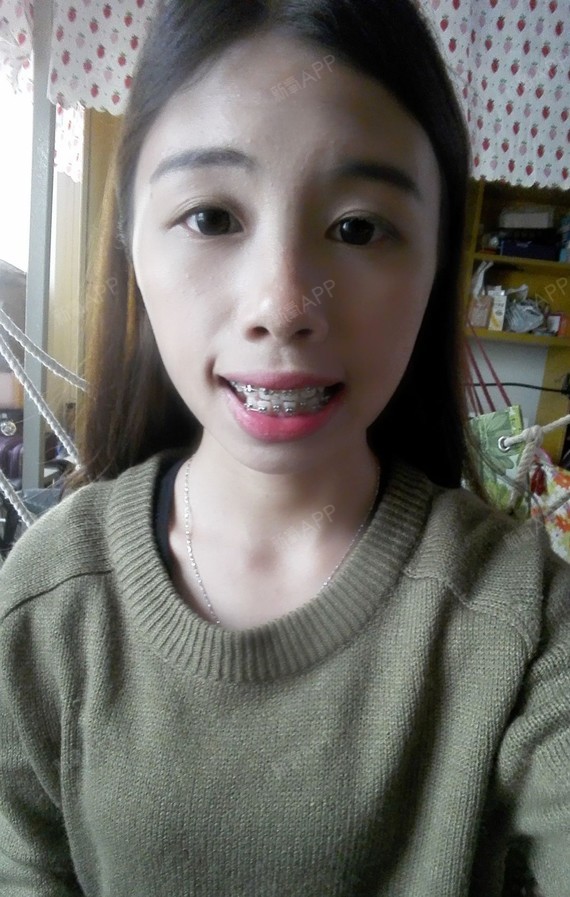 笑起来有自信,亲这边建议你马上戴牙套