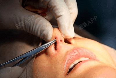 假体隆鼻会不会留疤是手术会有切口,有切口会破坏层,