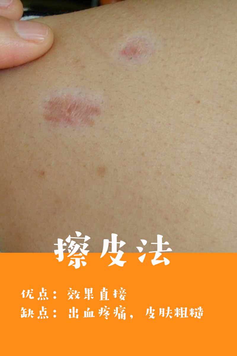 八种热门祛疤方法全科普