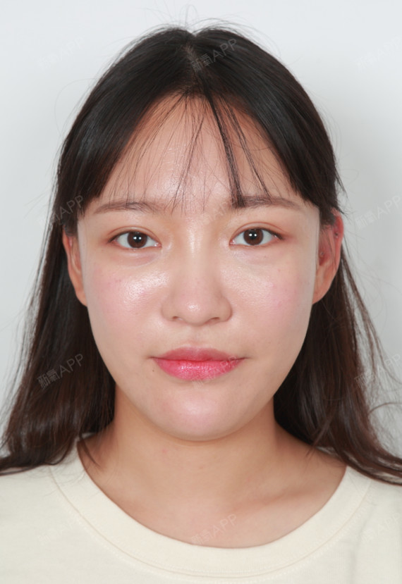 现在脸型饱满,笑起来特别的好看,照片上是淡妆,其实_圈子-新氧美容