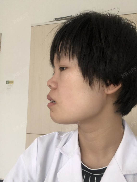 其他品牌 是否矫正完成:否 矫正费用:12000元        侧面明显的龅牙