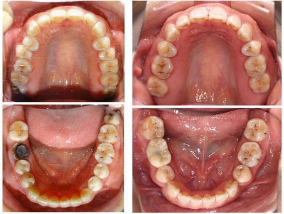 隐适美隐形牙套矫正重度前牙开合成人患者磨牙的压低一_圈子-新氧美容