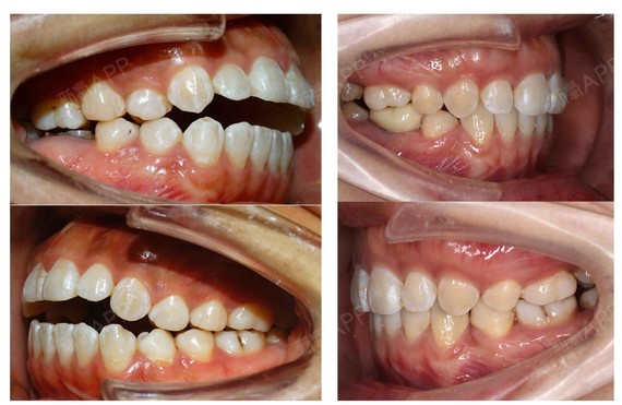 隐适美隐形牙套矫正重度前牙开合成人患者磨牙的压低一_圈子-新氧美容