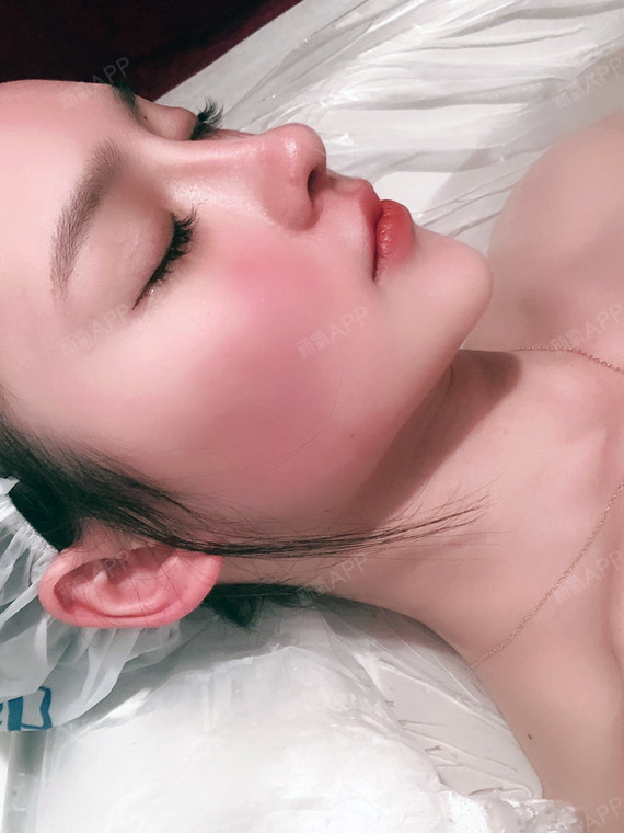 天津超体隆鼻好不好_效果图_再见人海超体隆鼻术后第67天_新氧美容