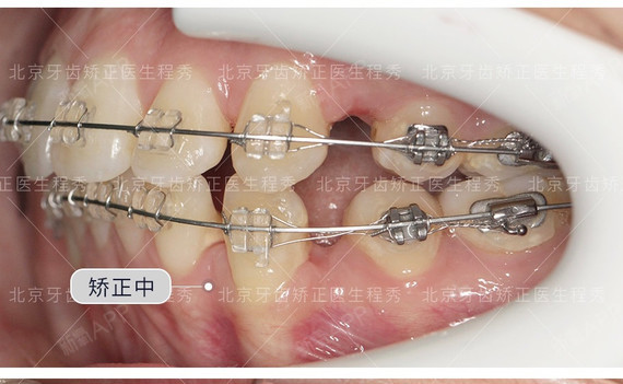 我今年25岁啦,陶瓷单晶托槽是我已经确定要做的事情_圈子-新氧美容