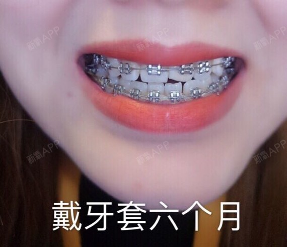 戴牙套的四五个月侧切牙出来了