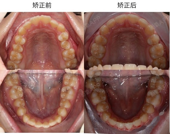 ▌矫正前后面像对比