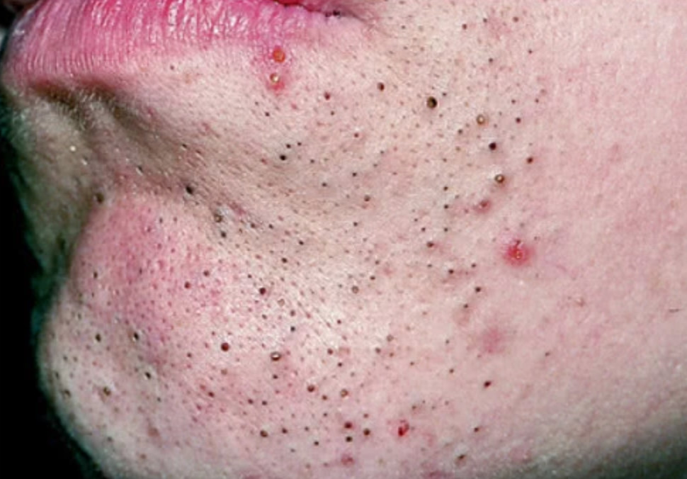 点阵激光祛黑头可以永久有效么?