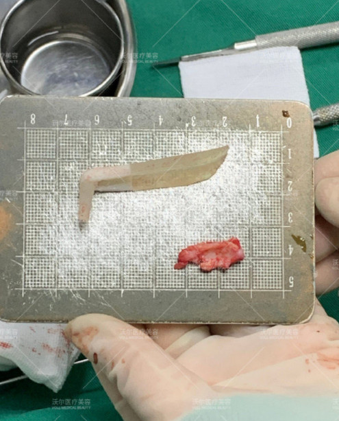 为什么我们不用l型假体材料做鼻部多项?