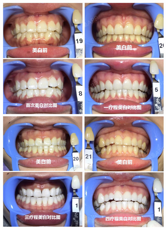 牙齿美白前后对比照片图片