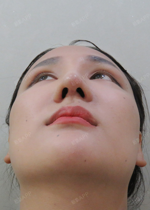 武汉唇腭裂手术好不好_效果图_幻想着你的梦想唇腭裂手术术后第85天