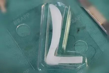 7878在隆鼻恢复初期,用手触及鼻部感到假体有轻微的晃动是正常的