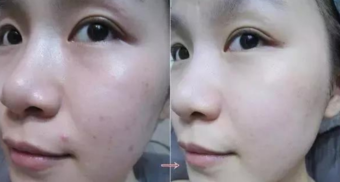 微针和水光补水哪个效果更好?