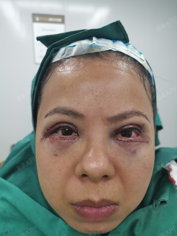 广西壮族自治区南宁外切去眼袋好不好_效果图_熊熊666外切去眼袋术后