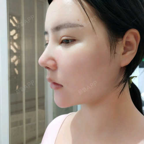 肋骨鼻修复第七天